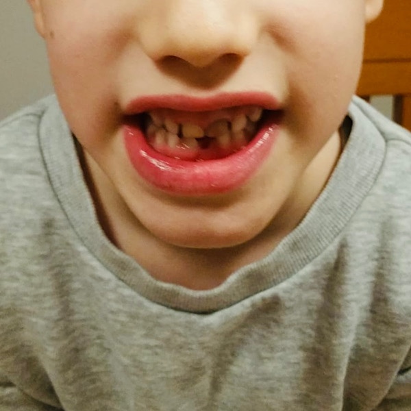Junge mit Zahnlücke